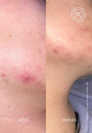 Anti-puistjescrème Zitcontrol, 40 ml