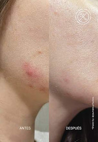 Anti Pickel Serum Postzit, 30 ml
