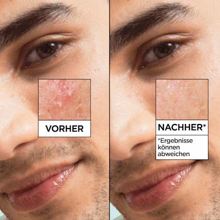Serum Salicylic, 30 ml