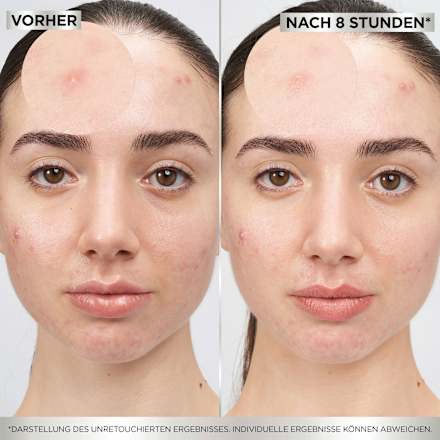 Anti-puistjes puistjespleisters hydrocolloïde, 22 stuks