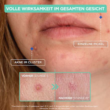 Anti Pickel Paste, 15 ml