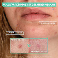 Anti Pickel Paste, 15 ml