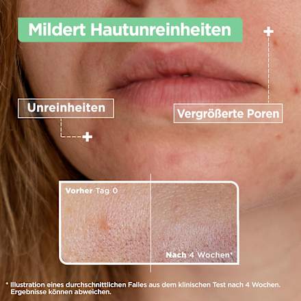 Serum Anti-Unreinheiten, Niacinamide, 30 ml