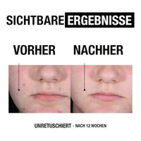 Anti-puistjes peeling reiniger AHA/PHA/BHA, 200 ml