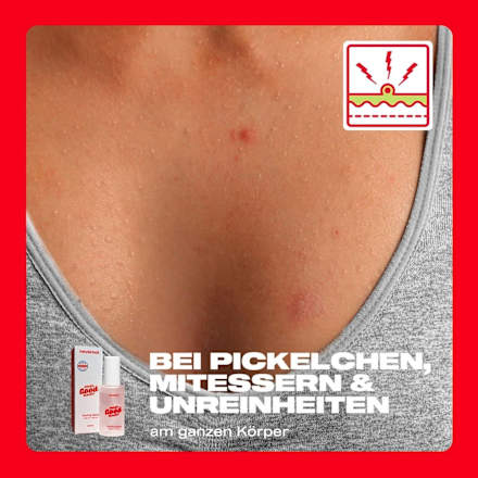 Peeling Spray Solution, 50 ml nevernot