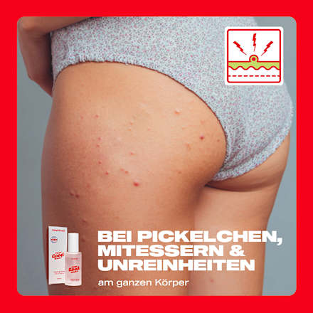 Peeling Spray Solution, 50 ml nevernot